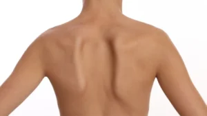 Scapular-Dyskinesis